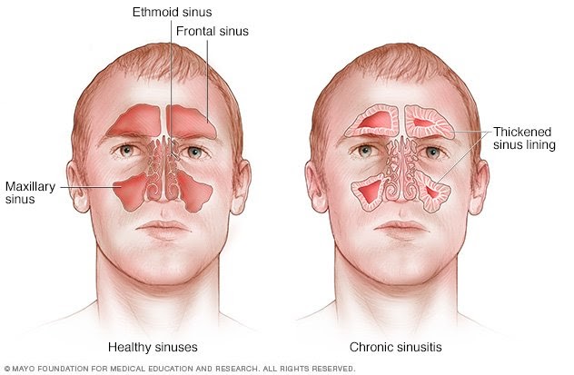 Sinus Drainage Meds