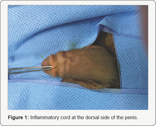 vein penis Deep thrombosis