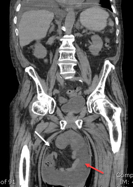 Can A Ct Scan Detect A Hernia Ct Scan Machine