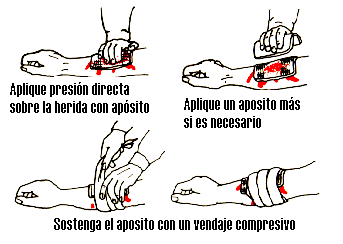 Presón Directa