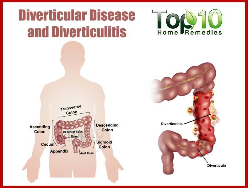 HOME REMEDIES FOR DIVERTICULAR DISEASE AND DIVERTICULITIS ~ Mzizi Mkavu