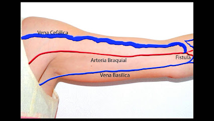 fistula