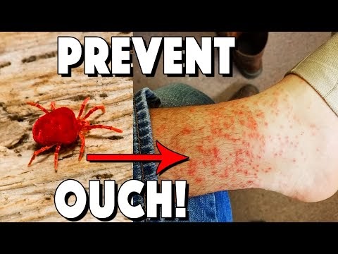 chiggers