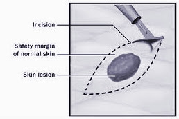 Skin Cancer Surgery | Information Sheets | Minor Surgery