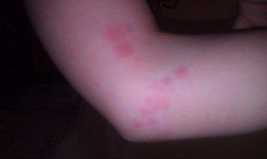 What Do Bedbug Bites Look Like On A Child Dowta