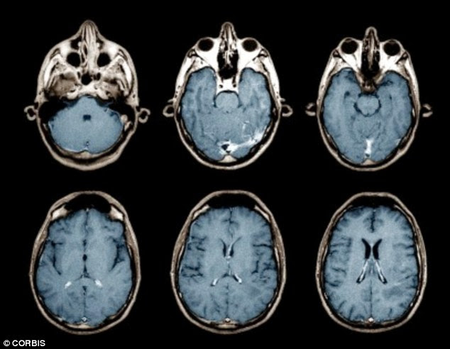Researchers at Stanford University found three differences after performing MRIs on a group of CFS patients and a control group of healthy volunteers with no history of CFS. File picture