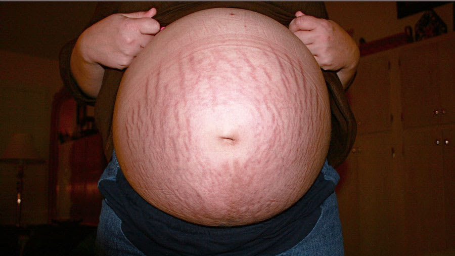 Red Marks On Belly When Pregnant Pregnantbelly