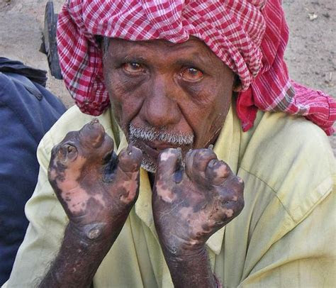 Leprosy Images