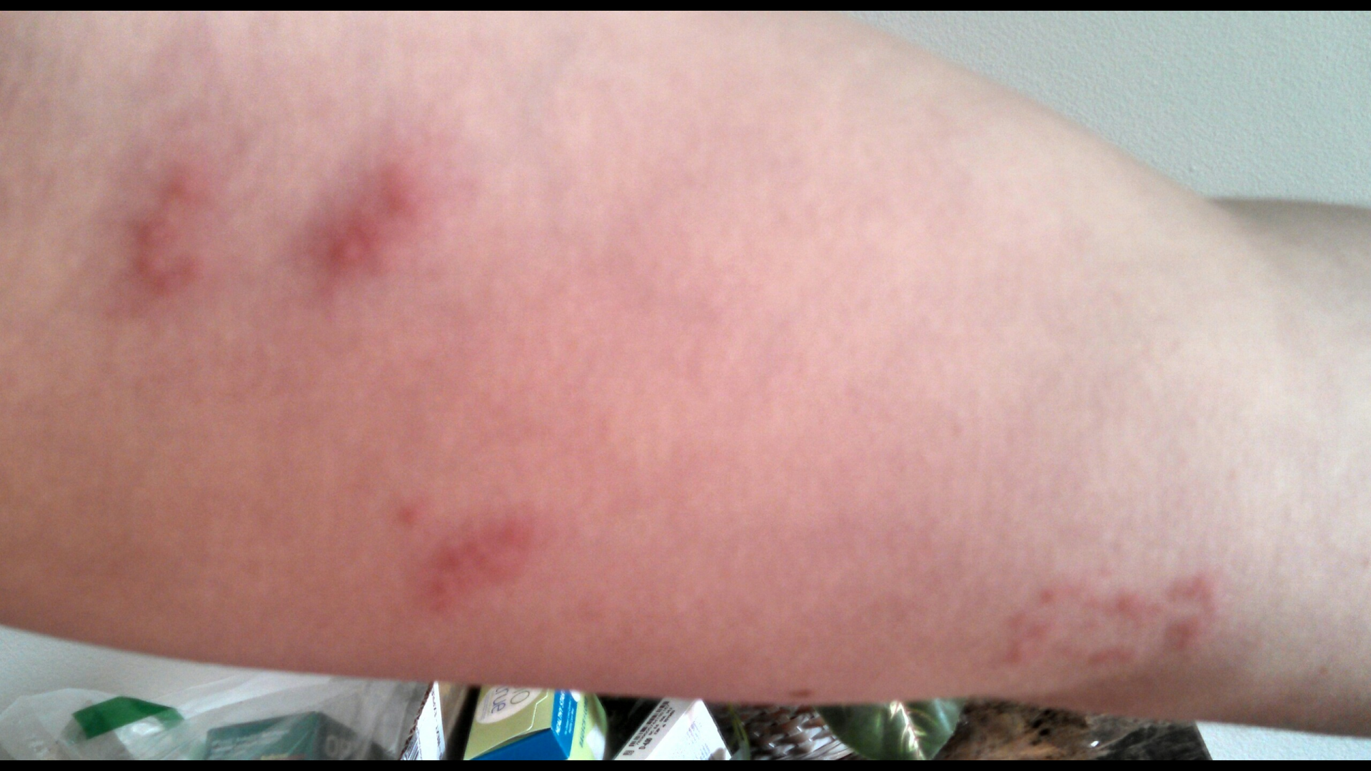 Bed Bug Rash Spreading Bangdodo