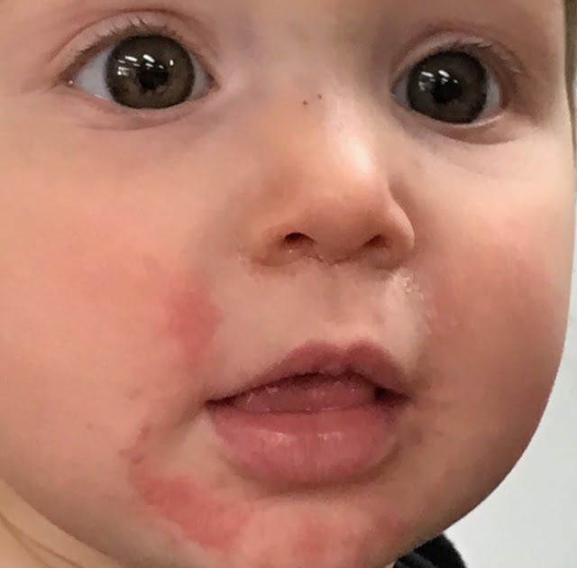 My Baby Has A Rash Around His Mouth Baby Viewer