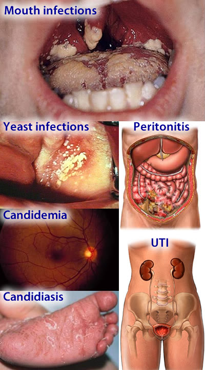 Diflucan Deal With Fungal Sinus Infection