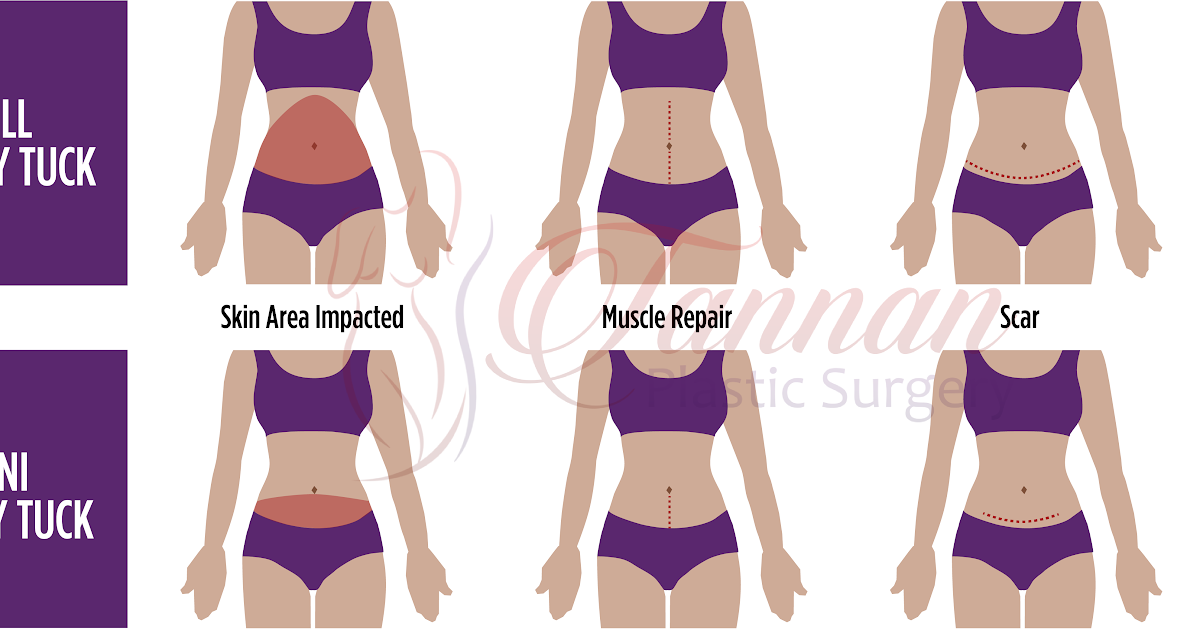 Can You Get Tummy Tuck During C Section 31 Unique and