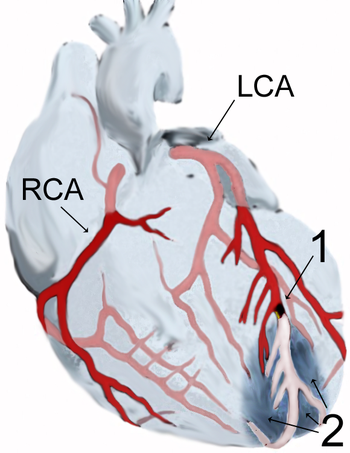 All The Patients Of Acute Myocardial Infarction (STEMI) May Not Require Oxygen Therapy