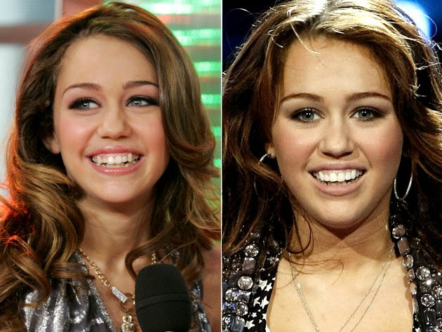 Miley Cyrus Before After Teeth - ictendavraniyor