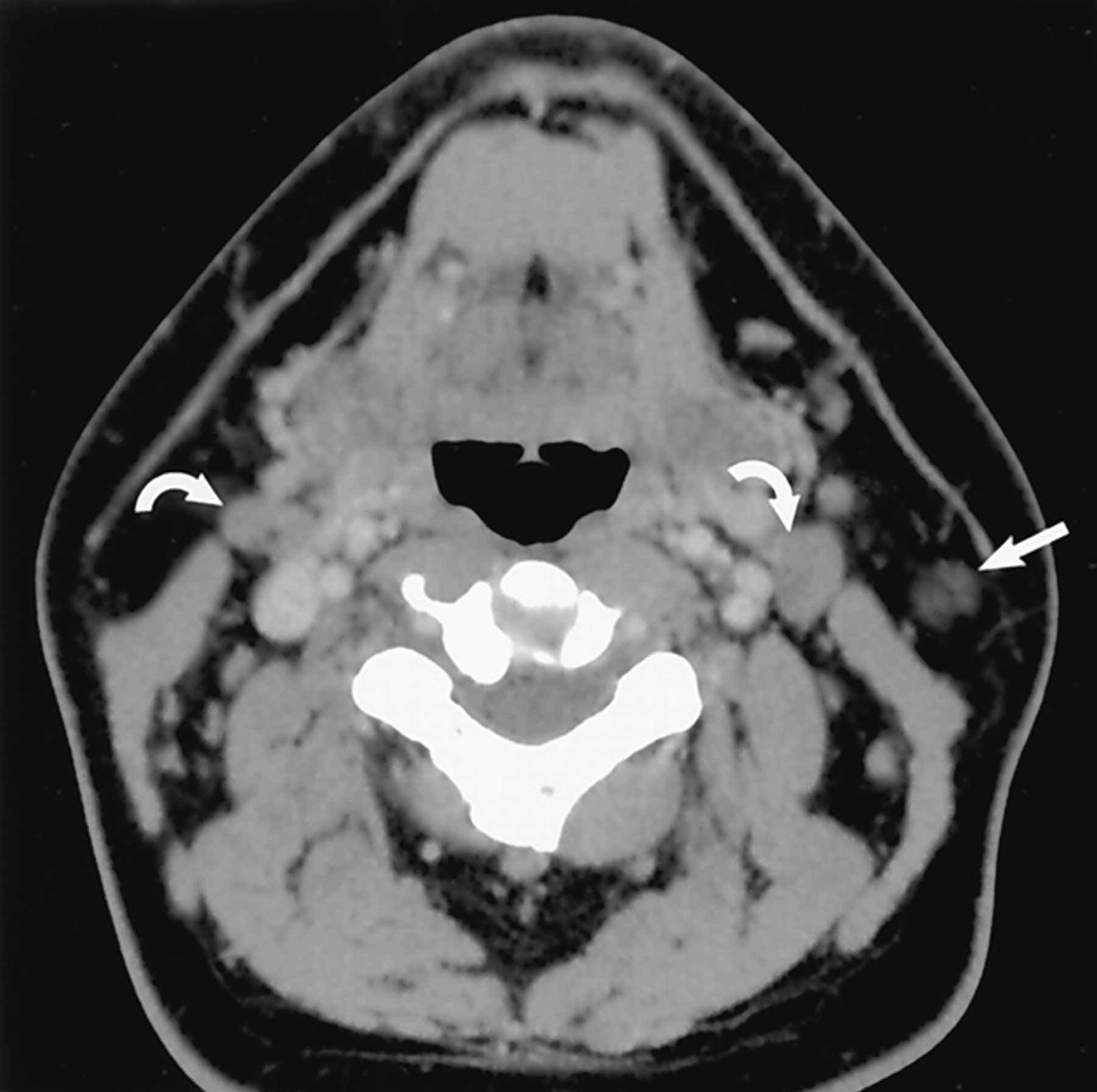 Normal Ct Scan Of Neck Lymph Nodes