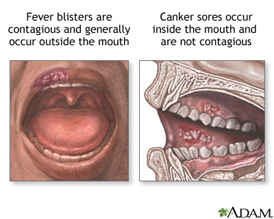 blister blisters sore fever sores canker mouth causes gums medlineplus gov herpes ulcers oral health remedies bottom painful virus body