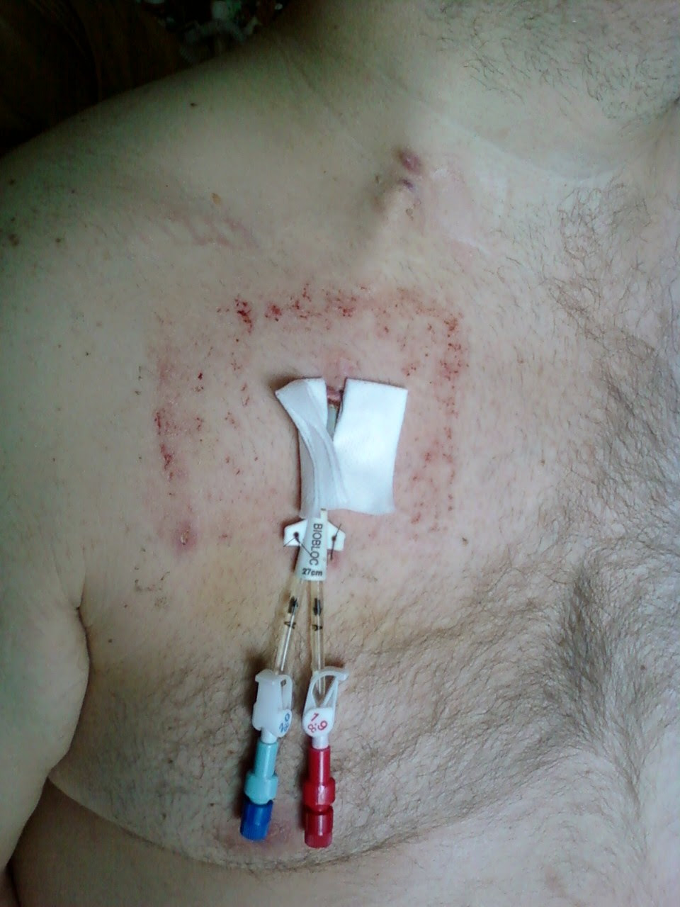 Dialysis Port On Chest Makdesybutsite