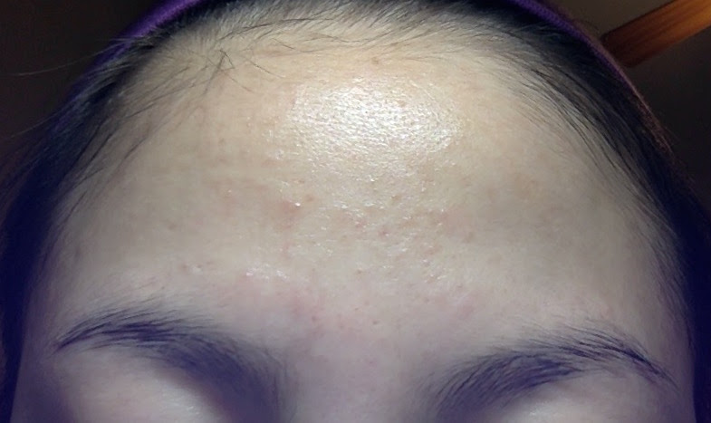 Folliculitis On Face Treatment Doctor Heck