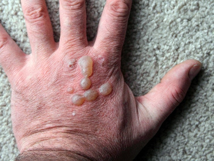 Itchy Bumps Filled With Clear Liquid Causes And Treatment Medical