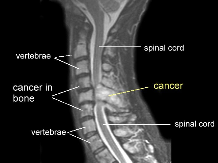 Spinal Cancer Xray CancerWalls