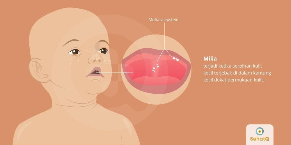 Cara Hilangkan Milia Israel Style