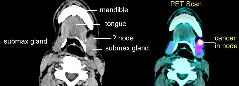 Normal Ct Scan Of Neck Lymph Nodes