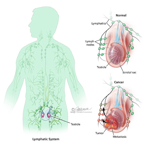 Types Of Testicular Lumps