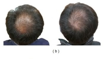 finasteride hair growth before and after