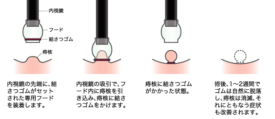 [最も人気のある！] 切れ 痔 治し 方 自力 323794