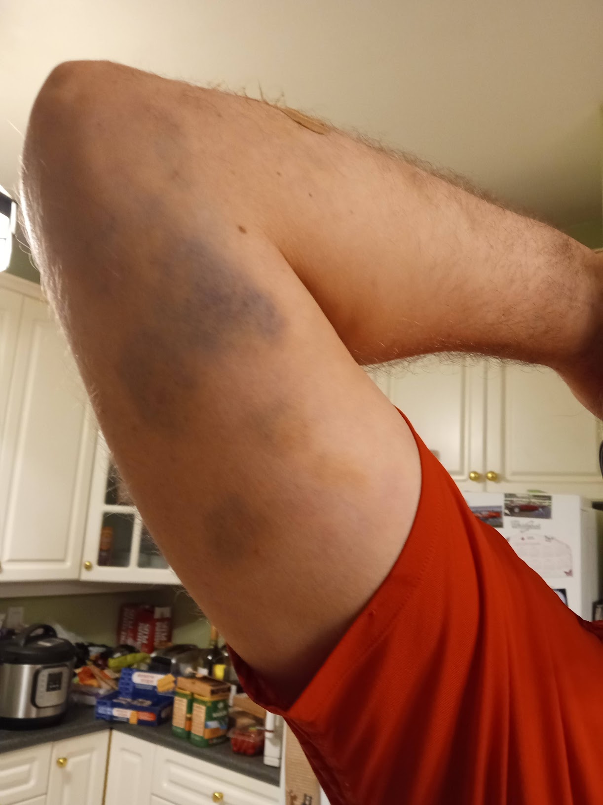 Bruised elbow