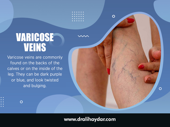 Varicose Veins