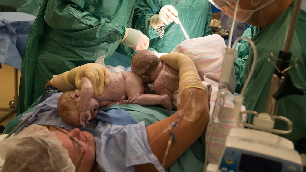 Incredible Moment: Mom Delivers Her Own Twins During C-Section