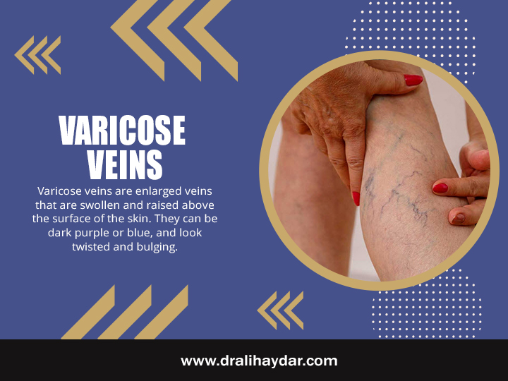 Varicose Veins Qatar