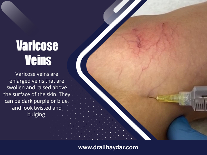 Varicose Veins Qatar