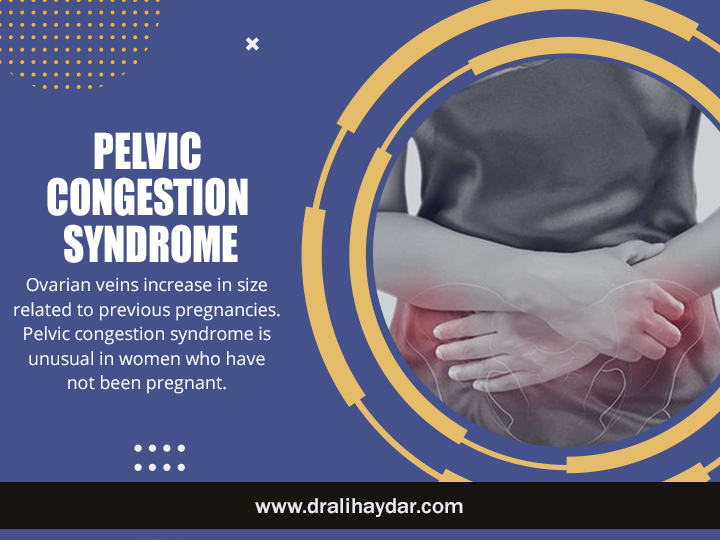 Pelvic Congestion Syndrome Qatar