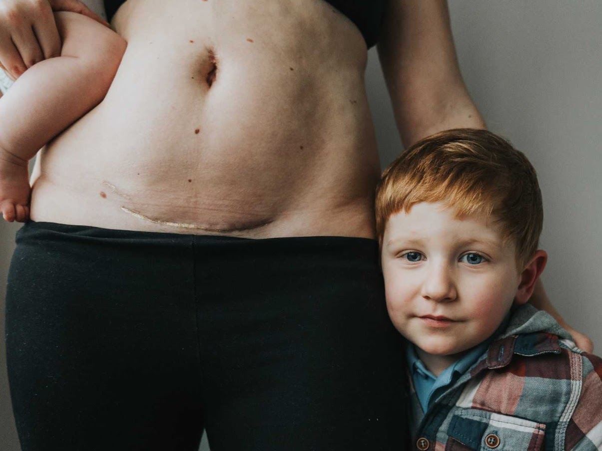 Photographer Rejoices Mothers’ Stretch Marks, Scars In Gorgeous Gold Dust Project