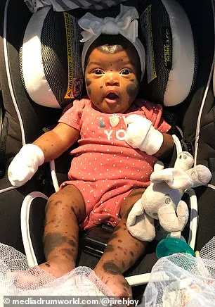 A Beautiful Baby Girl Was Born With A Unique Condition That Has Caused Dark Spots All Over Her Body.