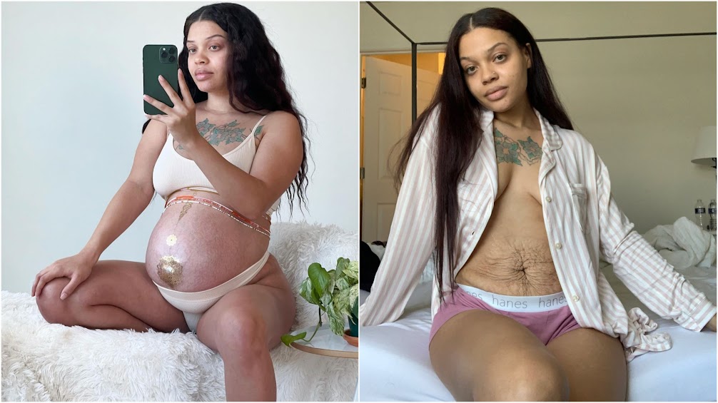 Mom Sharing Postpartum Body To Take On Society’s Ridiculous Expectations