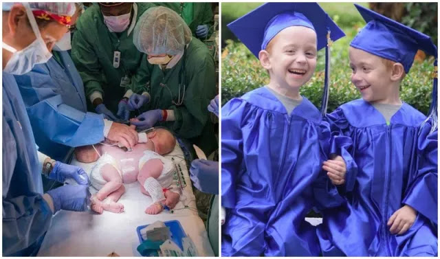 Doctors Said Conjoined Twins Wouldn’t Survive But They Just Graduated From Kindergarten.