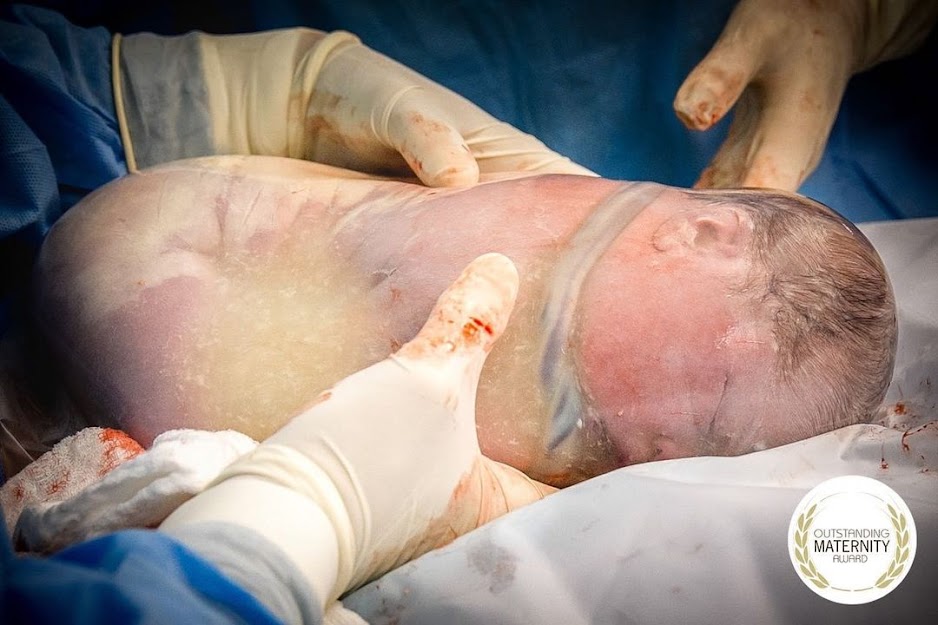 En Caul Births: 25 Rare Photos of Babies Born in the Amniotic Sac