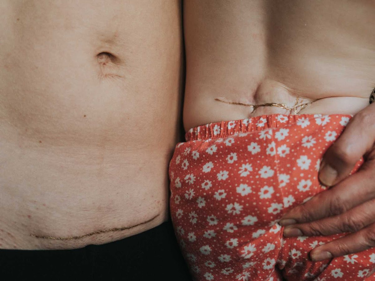 Photographer Rejoices Mothers’ Stretch Marks, Scars In Gorgeous Gold Dust Project