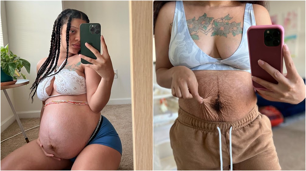 Mom Sharing Postpartum Body To Take On Society’s Ridiculous Expectations