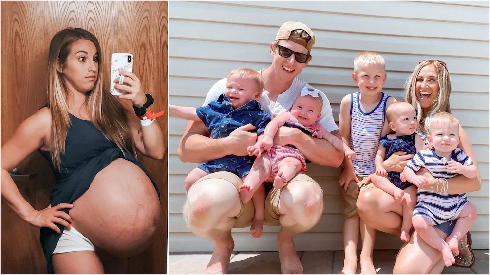 Quadruplets' Mom Shares Incredible Before-and-after Pregnancy Photos