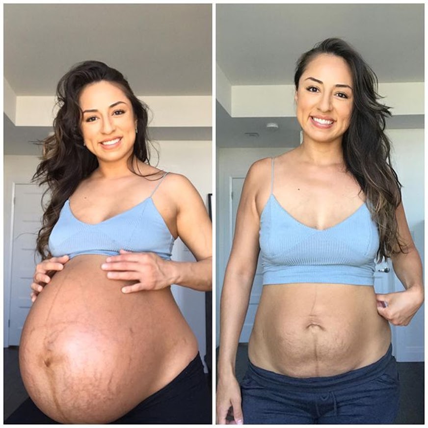 Twins Mom’s Amazing Before-And-After Pregnancy Photos Go Viral