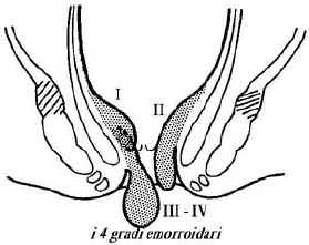 classificazione delle emorroidi