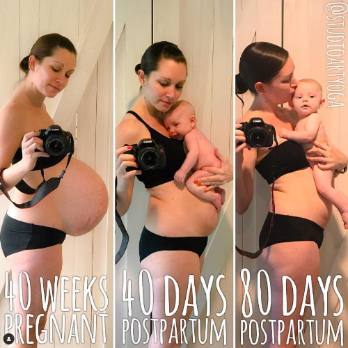 Mum Shares Incredible Stretch Marks Journey Pregnancy With Pride