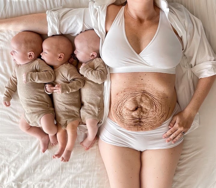 Mom of Triplets Shows off Her Pre and Post-birth Belly