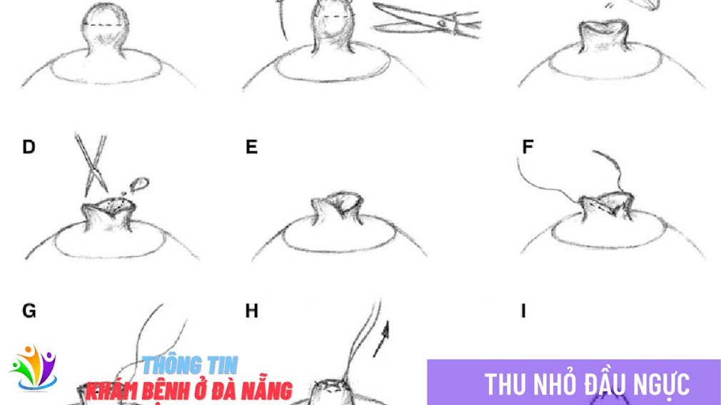 KỸ THUẬT THU NHỎ ĐẦU NGỰC