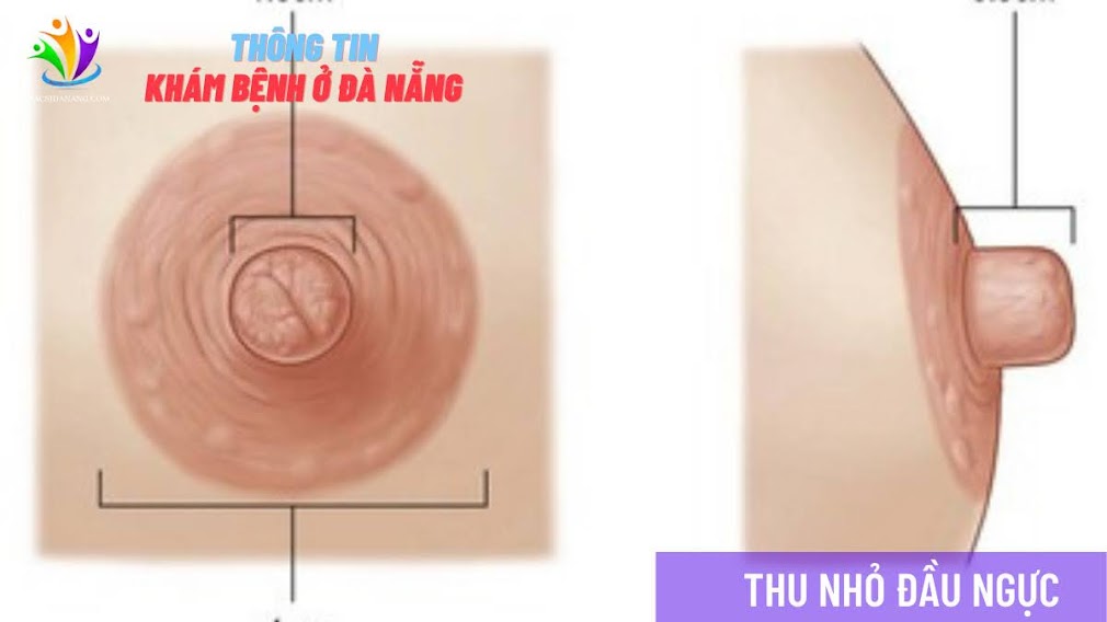 KỸ THUẬT THU NHỎ ĐẦU NGỰC