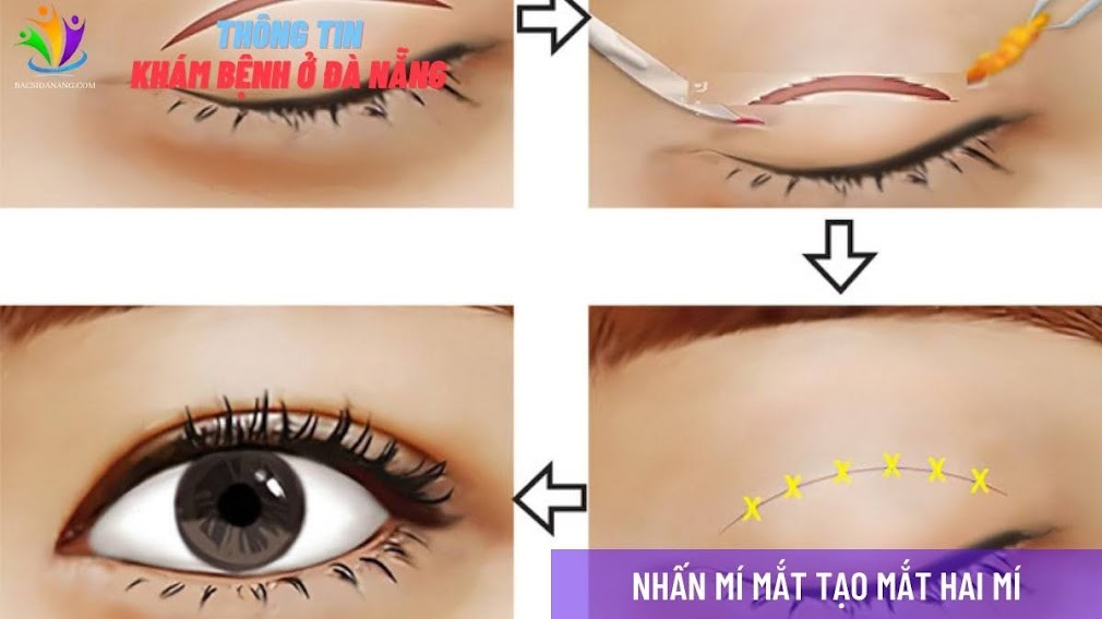 NHẤN MÍ MẮT TẠI ĐÀ NẴNG